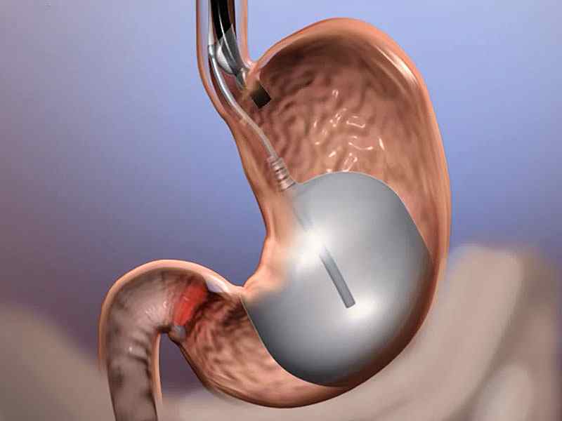 Palloncino gastrico in Tunisia: posizionamento senza chirurgia