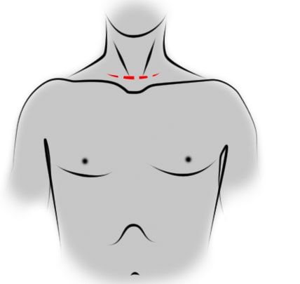Cervicotomia in Tunisia