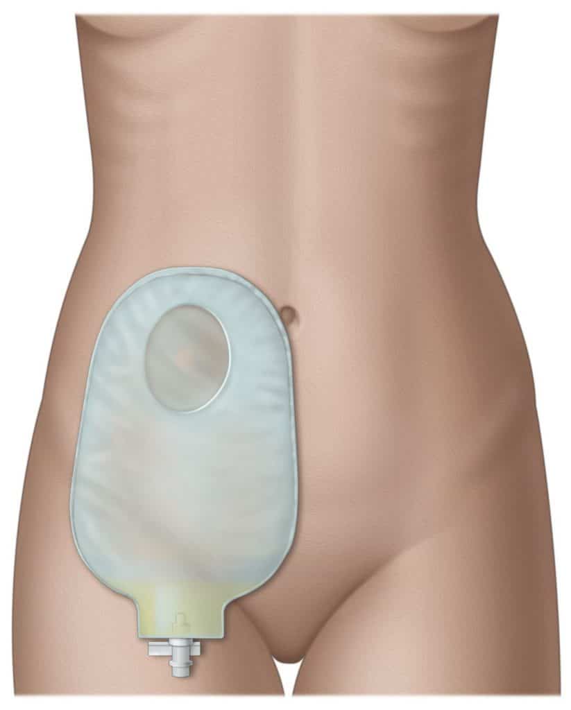 Cistectomia e derivazione urinaria in Tunisia prezzo basso