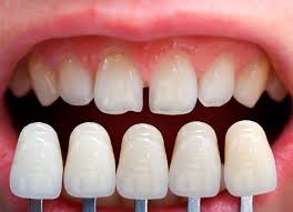 faccette dentali in Tunisia prezzo economico