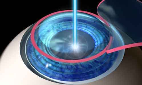 lasik astigmatismo eccimeri in tunisia prezzo tariffa economica