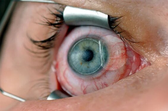 lasik presbiopia in Tunisia prezzo basso