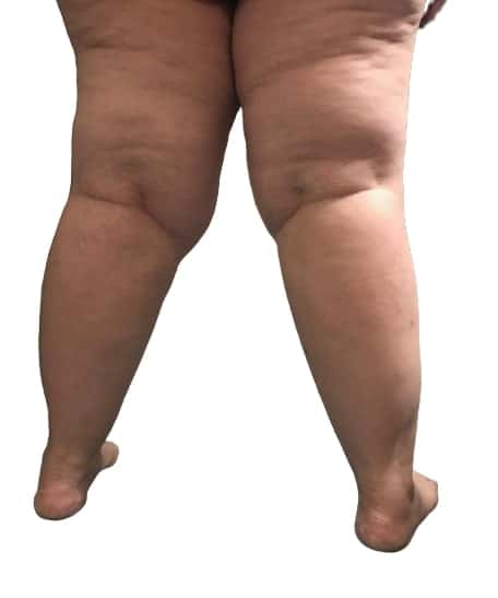 Chirurgia del lipedema in Tunisia prezzi accessibili e convenienti