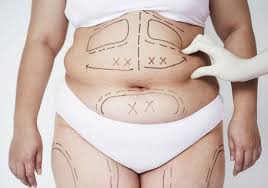 Liposuzione Full HD trattamento contouring muscolare Tunisia