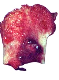 Osteoma osteoide in Tunisia a basso costo