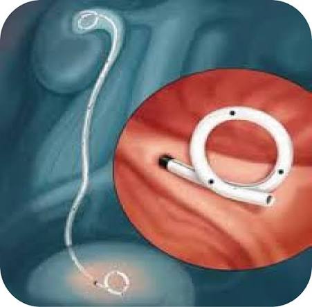 Stent doppio J Tunisia