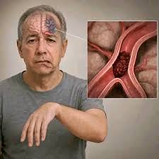 Tromboflebite cerebrale - diagnostica RM in Tunisia