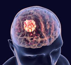 Tumori cerebrali - diagnostica RM e neurochirurgia in Tunisia