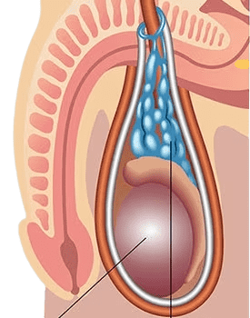 Varicocele in Tunisia